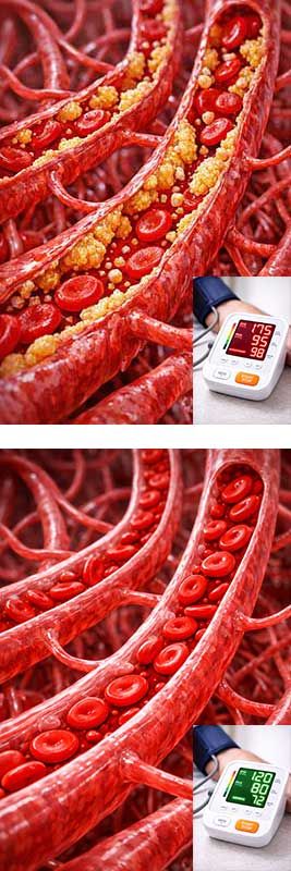 Hypertension Zalmanov bath therapy